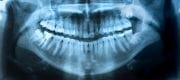 A revolution in dental implants